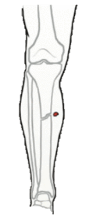 Grade I open fracture clinical illustration